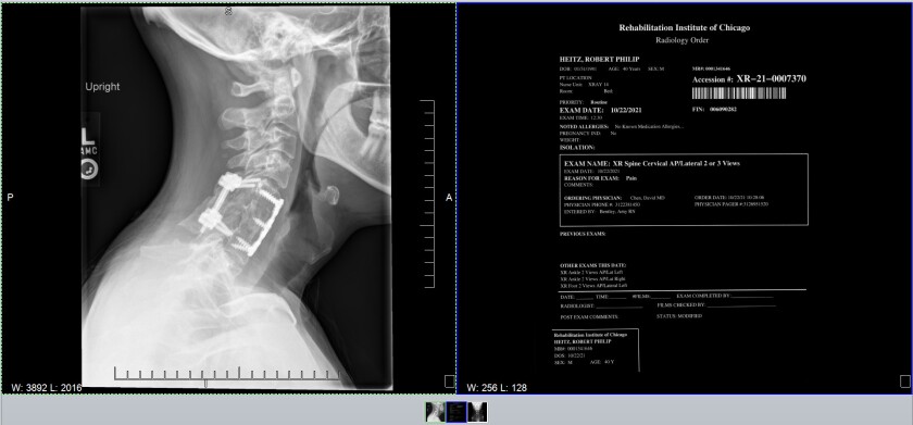 An X-ray of Rob Heitz’s neck, showing the titanium screws and plates holding his vertebrae together.
