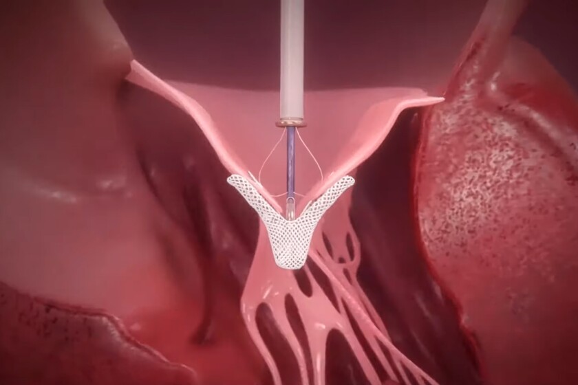Screengrab of an Abbott video that illustrates the workings of the heart’s mitral valve and two types of mitral regurgitation, primary and secondary.