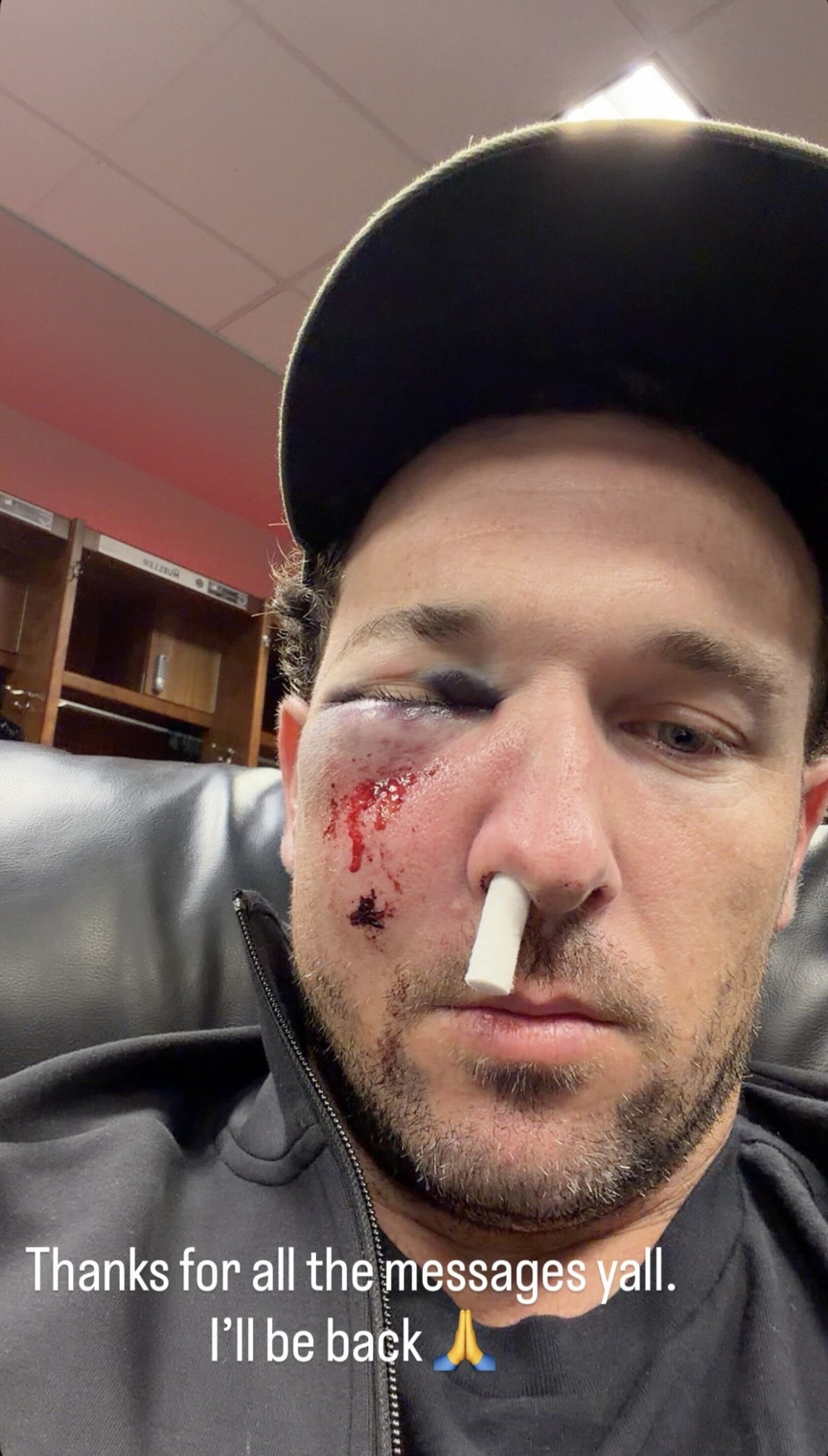 Multiple Fracture Picture Cubs’ Alex Bregman shares photos after taking foul ball to face ...