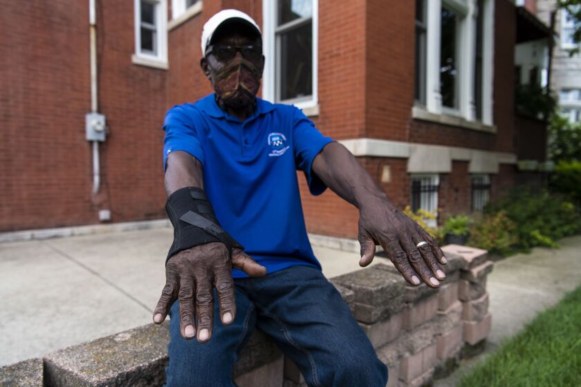 Arthur Turner Sr., a former member of the Illinois House of Representatives, shows the case from an injury he suffered while he was being arrested by police.