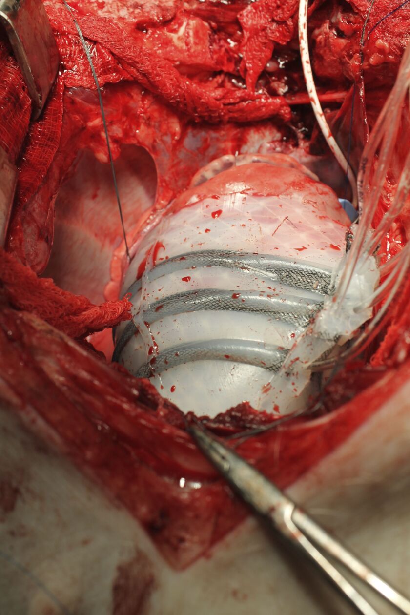 In this photo provided by Harvard University, a pig’s heart encased in a robotic sleeve designed to gently squeeze a diseased heart so it better pumps blood. Researchers at Harvard and Boston Children’s Hospital developed the experimental device in hopes