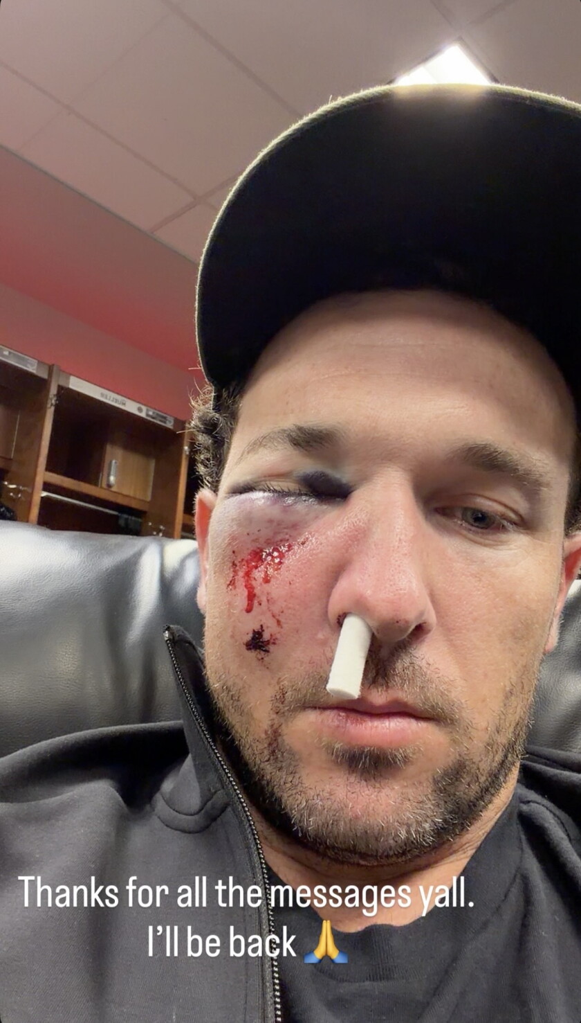 Multiple Fracture Picture Cubs’ Alex Bregman shares photos after taking foul ball to face ...