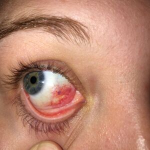 Close-up of a stitch on Sutton Dryfhout’s right eye on Sept. 7, 2017, after Dr. Benjamin Ticho allegedly operated on it by mistake on Aug. 21, 2017. | Provided photo, courtesy Leopold and Associates